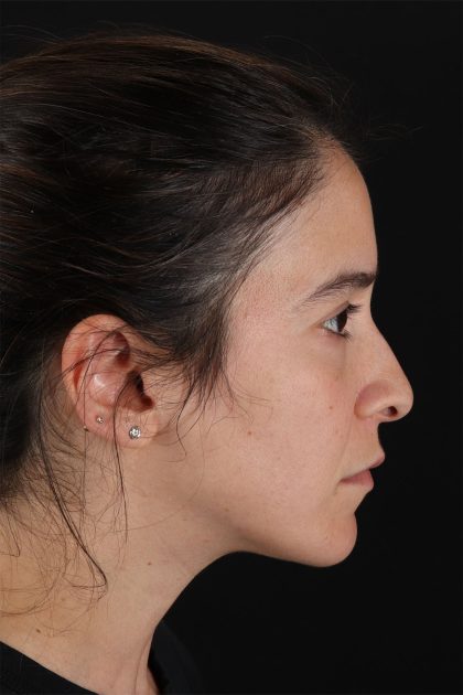 CO2 Laser Before & After Patient #11103