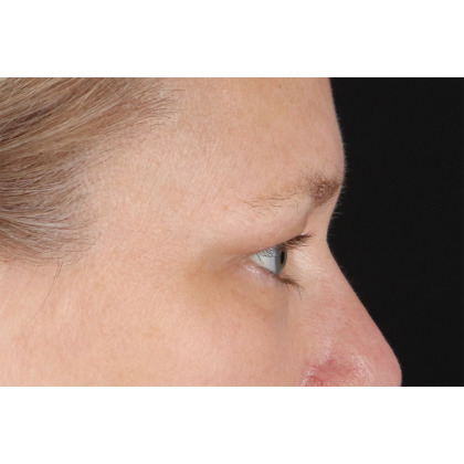 Blepharoplasty (Eyelid Surgery) Before & After Patient #10991