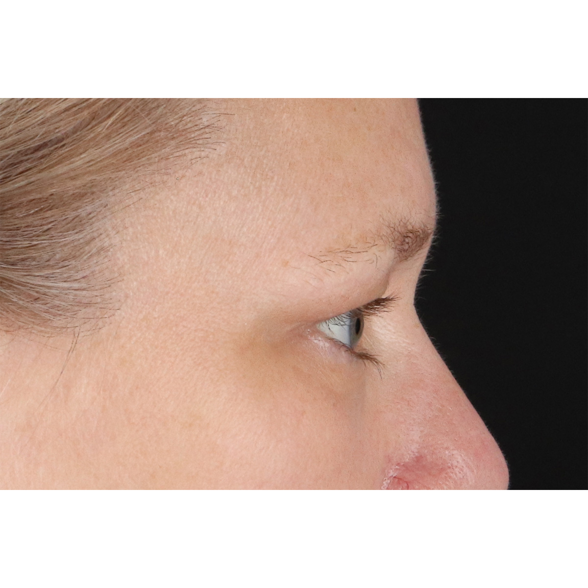 Blepharoplasty (Eyelid Surgery) Before & After Patient #10991