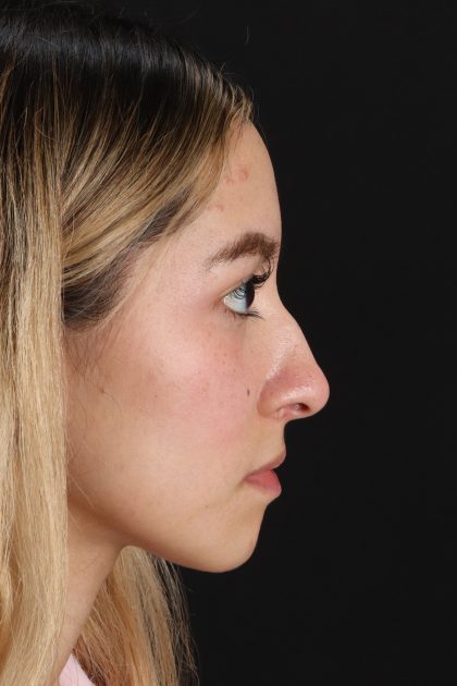 Rhinoplasty Before & After Patient #12216