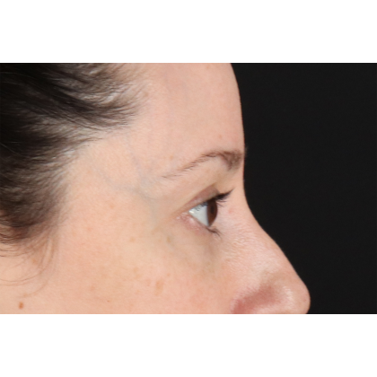 Blepharoplasty (Eyelid Surgery) Before & After Patient #11114
