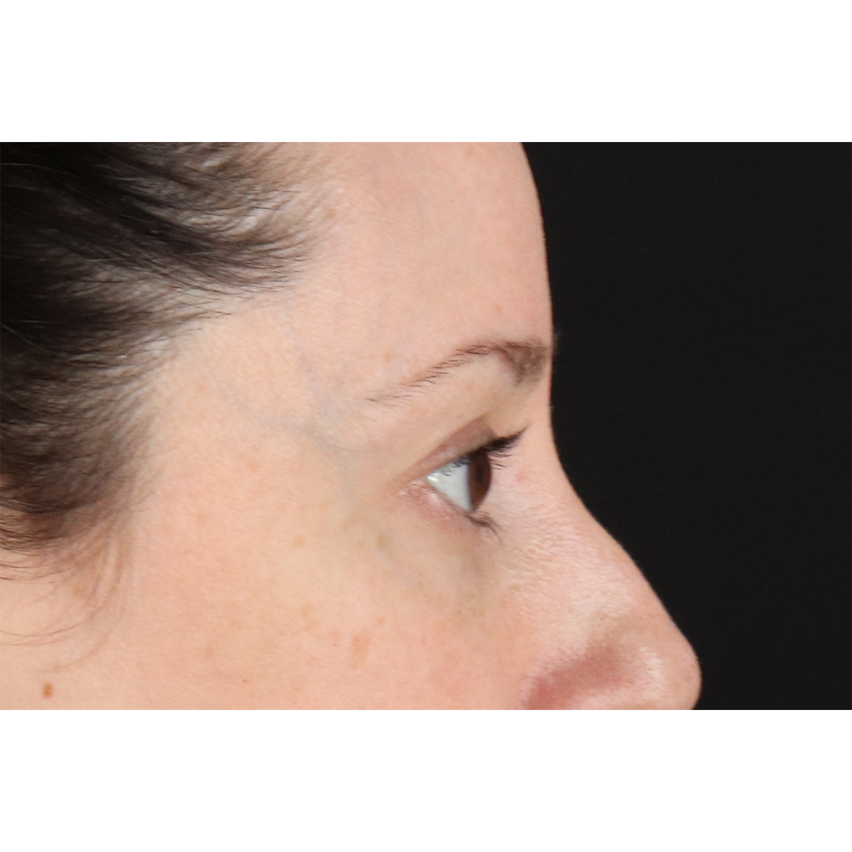 Blepharoplasty (Eyelid Surgery) Before & After Patient #11114