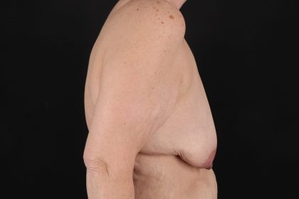 Breast Reduction With Lift Before & After Patient #10925