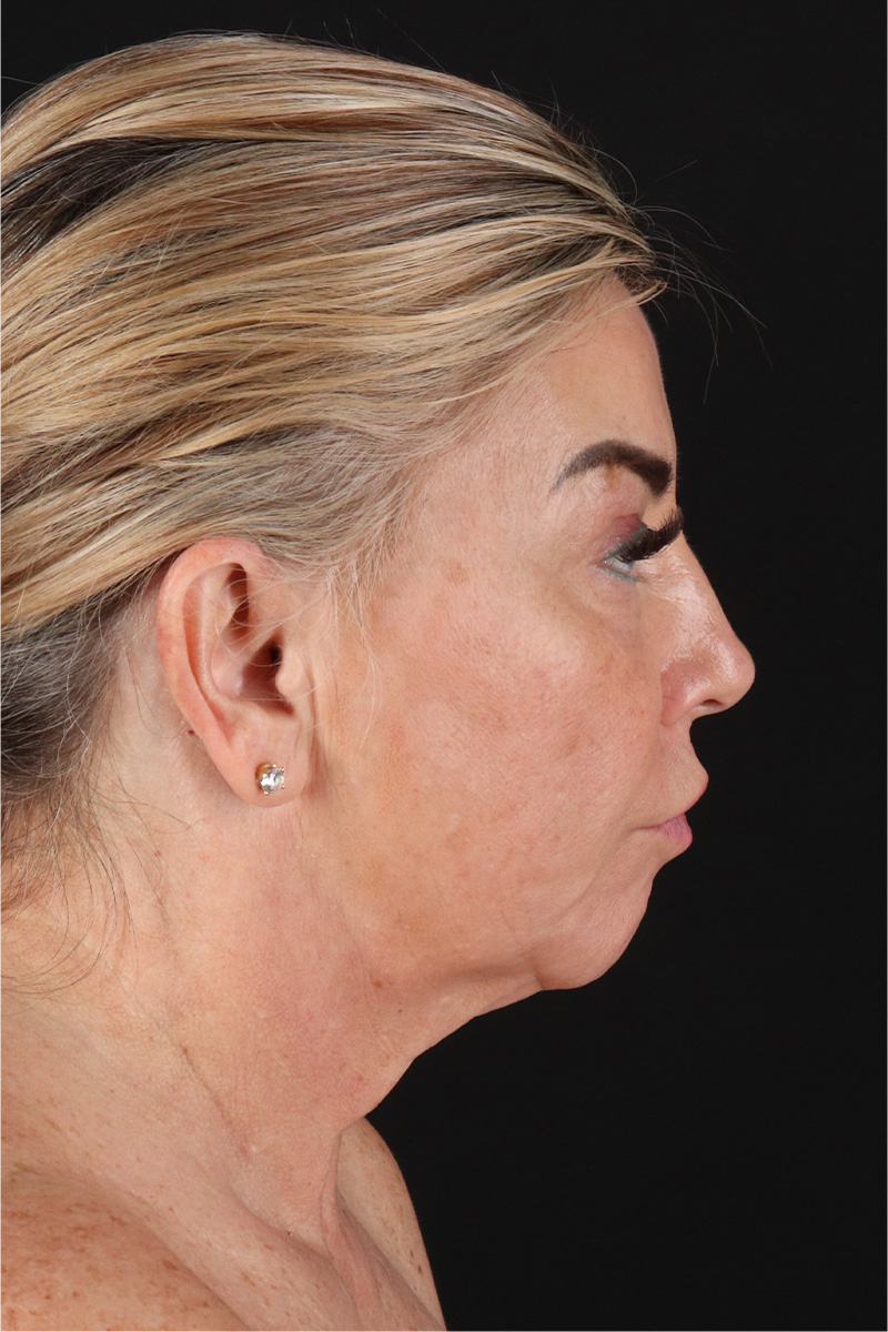 Facelift Before & After Patient #11462