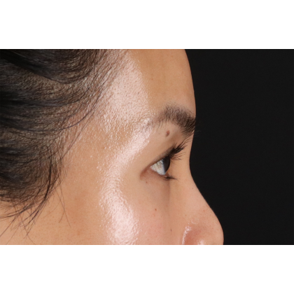 Blepharoplasty (Eyelid Surgery) Before & After Patient #10782