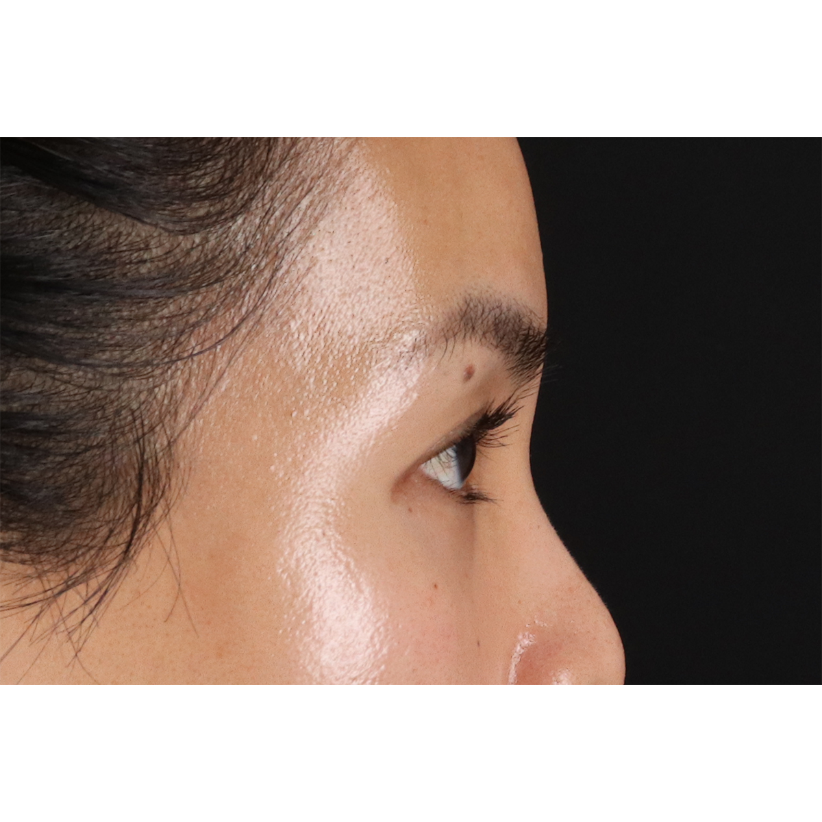 Blepharoplasty (Eyelid Surgery) Before & After Patient #10782