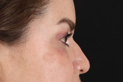 Rhinoplasty Before & After Patient #12656