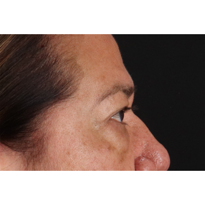 Blepharoplasty (Eyelid Surgery) Before & After Patient #11125