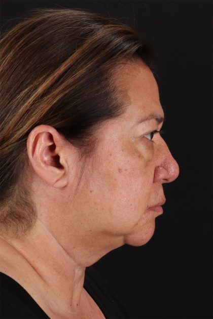 CO2 Laser Before & After Patient #11136