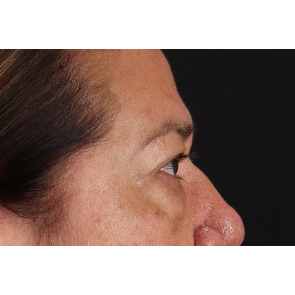 Blepharoplasty (Eyelid Surgery) Before & After Patient #11125