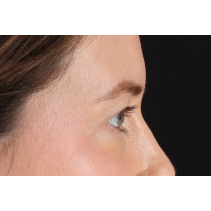 Blepharoplasty (Eyelid Surgery) Before & After Patient #11517