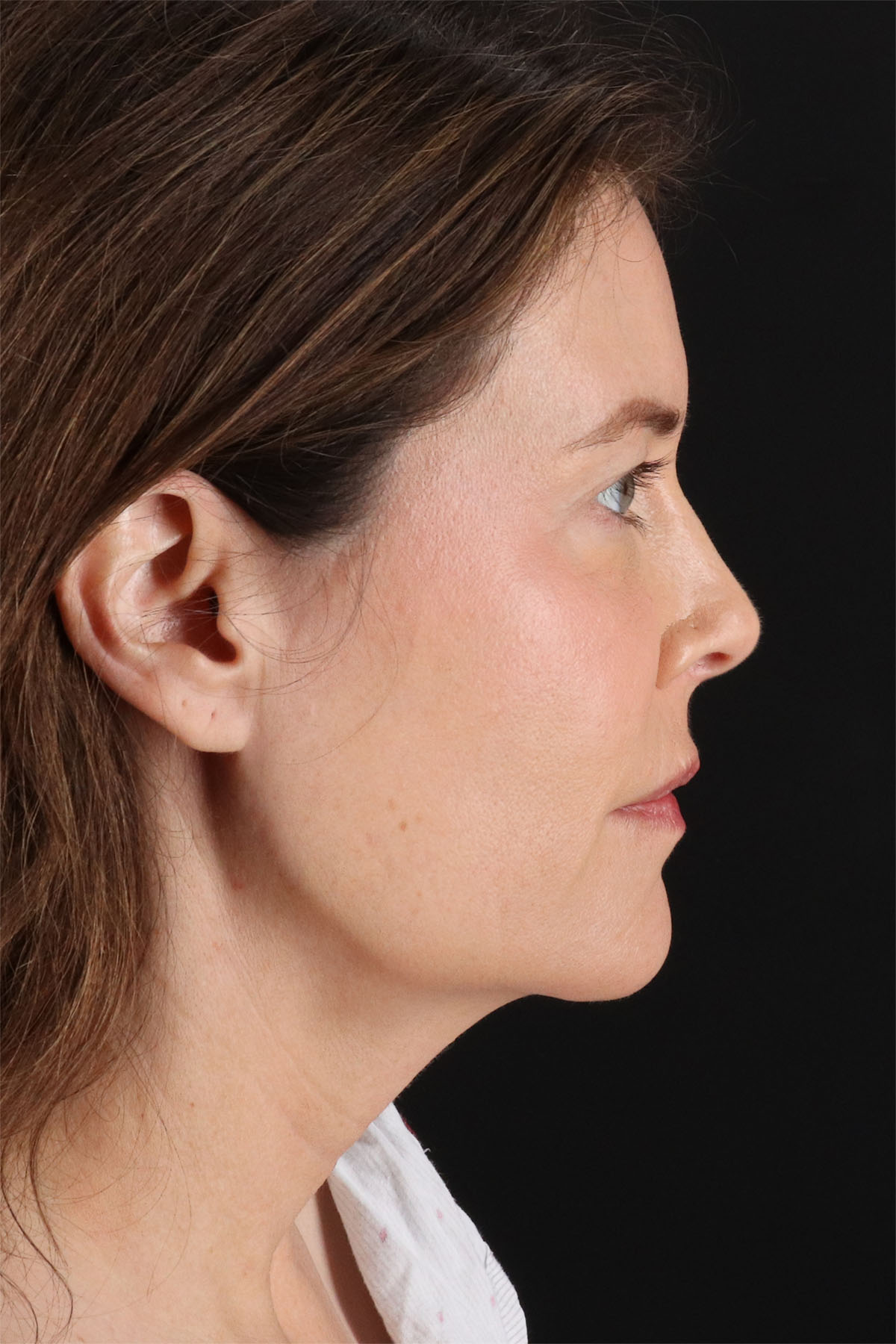 Fat Grafting To The Face Before & After Patient #11817