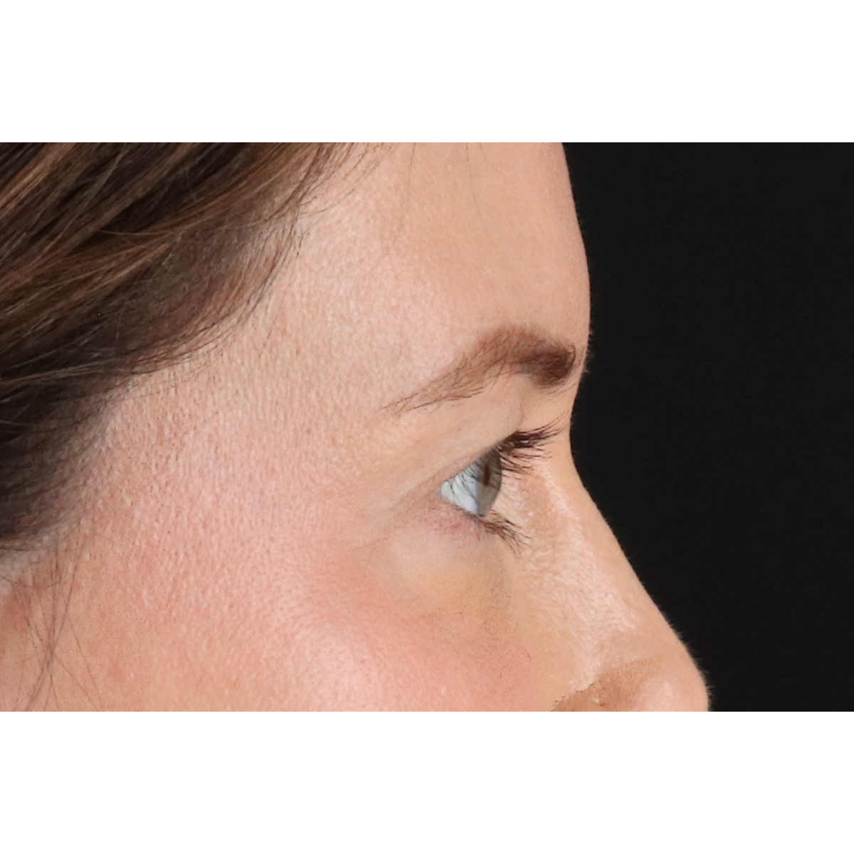 Blepharoplasty (Eyelid Surgery) Before & After Patient #11517