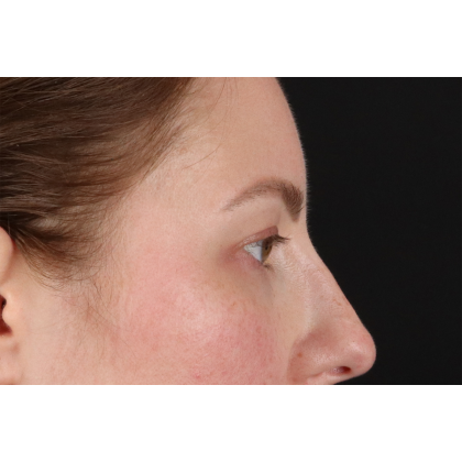 Brow Lift Before & After Patient #11657