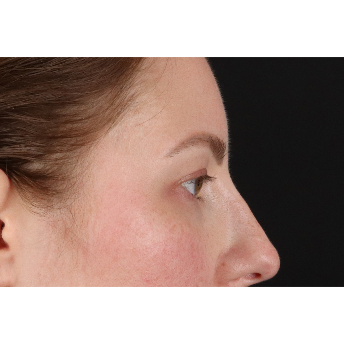 Brow Lift Before & After Patient #11657