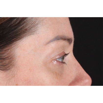 Blepharoplasty (Eyelid Surgery) Before & After Patient #11026