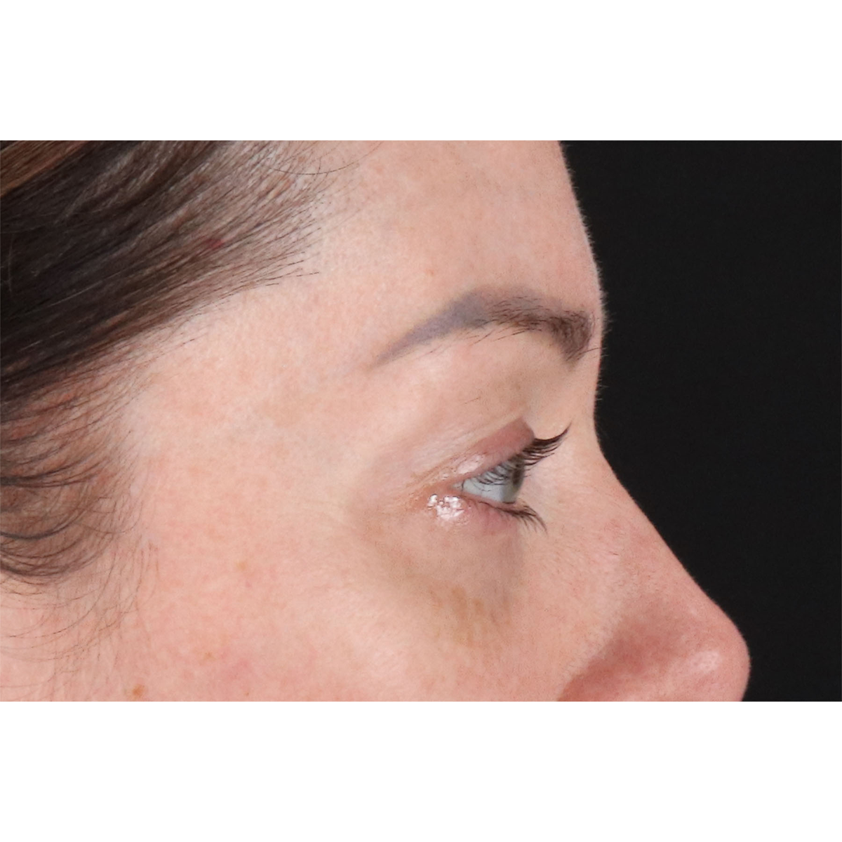 Blepharoplasty (Eyelid Surgery) Before & After Patient #11026