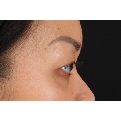 Blepharoplasty (Eyelid Surgery) Before & After Patient #11037