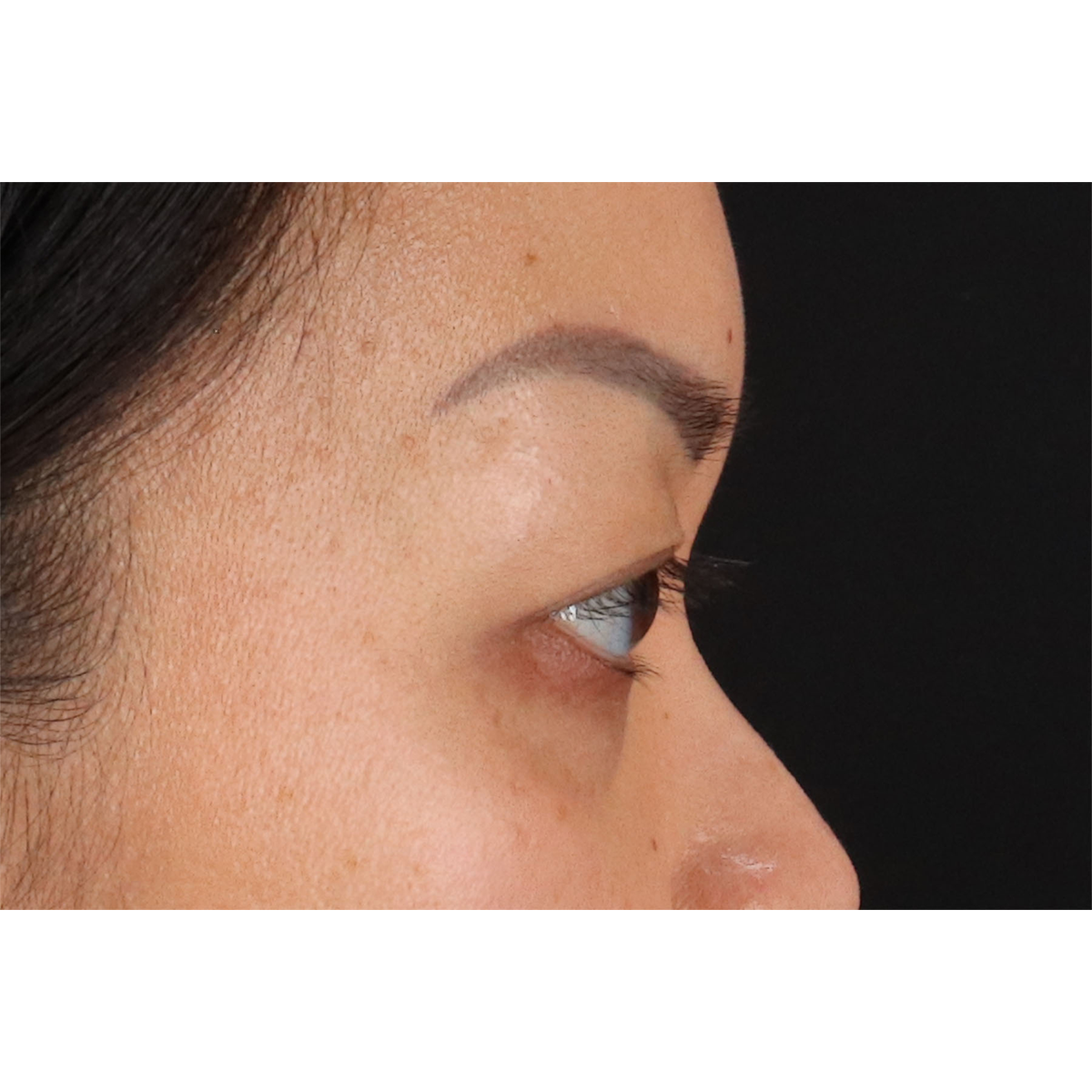 Blepharoplasty (Eyelid Surgery) Before & After Patient #11037