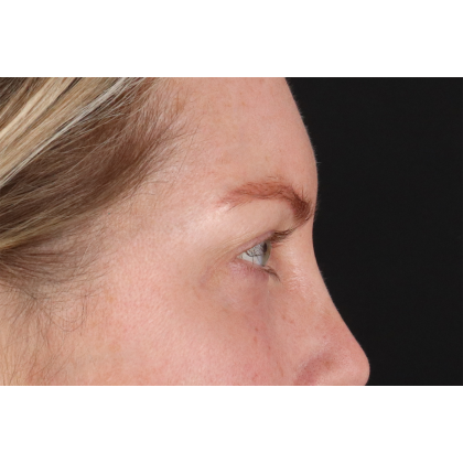 Blepharoplasty (Eyelid Surgery) Before & After Patient #11158