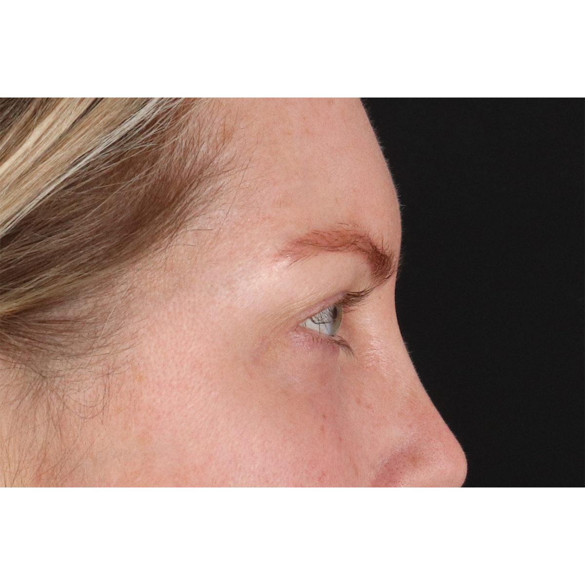 Blepharoplasty (Eyelid Surgery) Before & After Patient #11158