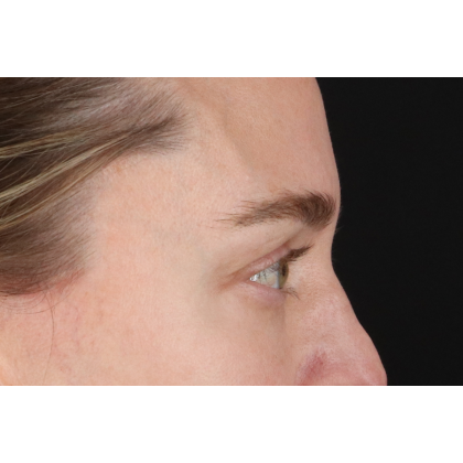 Blepharoplasty (Eyelid Surgery) Before & After Patient #11541