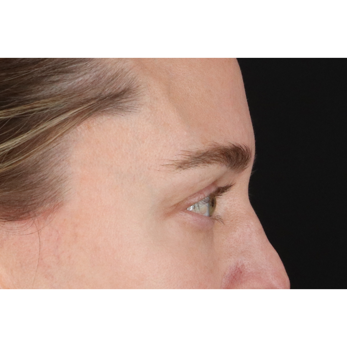 Blepharoplasty (Eyelid Surgery) Before & After Patient #11541