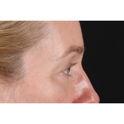 Blepharoplasty (Eyelid Surgery) Before & After Patient #11883