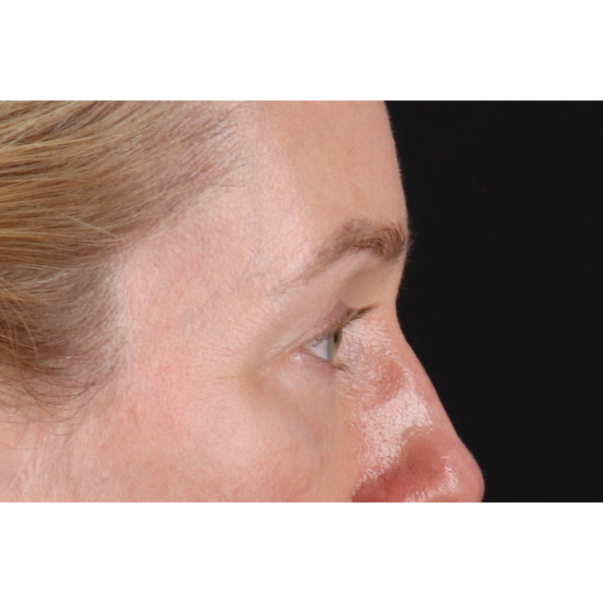 Blepharoplasty (Eyelid Surgery) Before & After Patient #11883