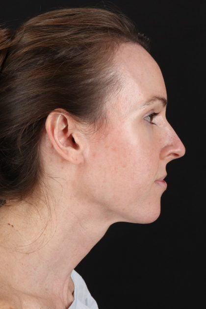 Fat Grafting To The Face Before & After Patient #11974