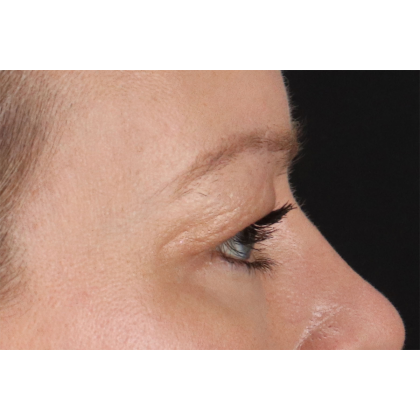 Blepharoplasty (Eyelid Surgery) Before & After Patient #11048