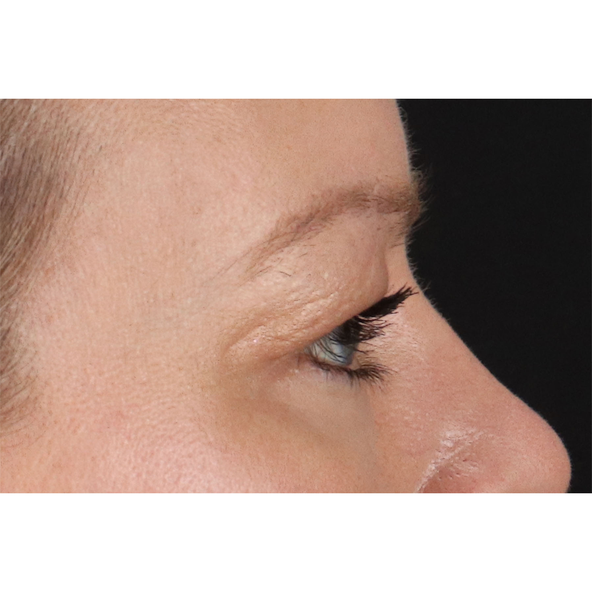 Blepharoplasty (Eyelid Surgery) Before & After Patient #11048