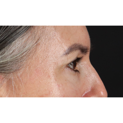Blepharoplasty (Eyelid Surgery) Before & After Patient #11282