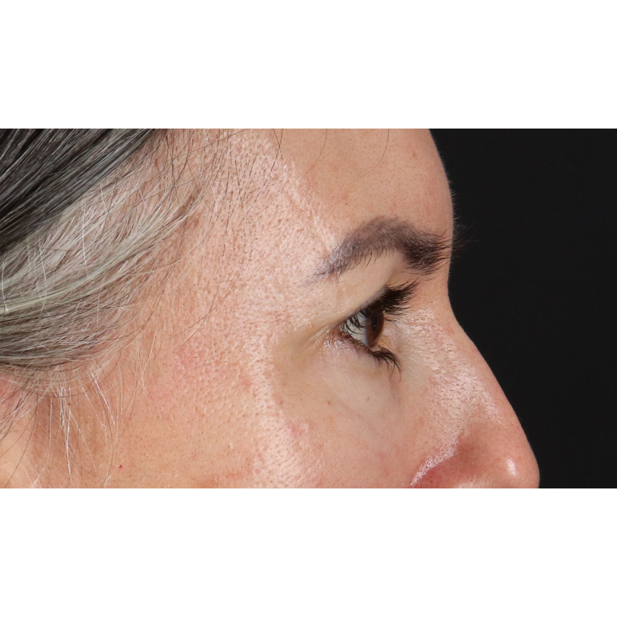 Blepharoplasty (Eyelid Surgery) Before & After Patient #11282