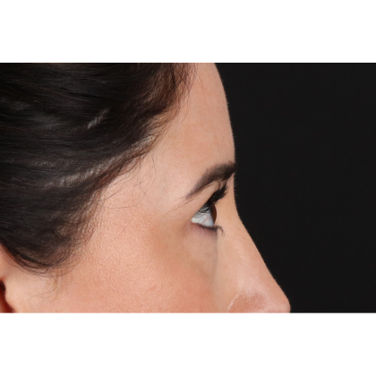 Blepharoplasty (Eyelid Surgery) Before & After Patient #11668
