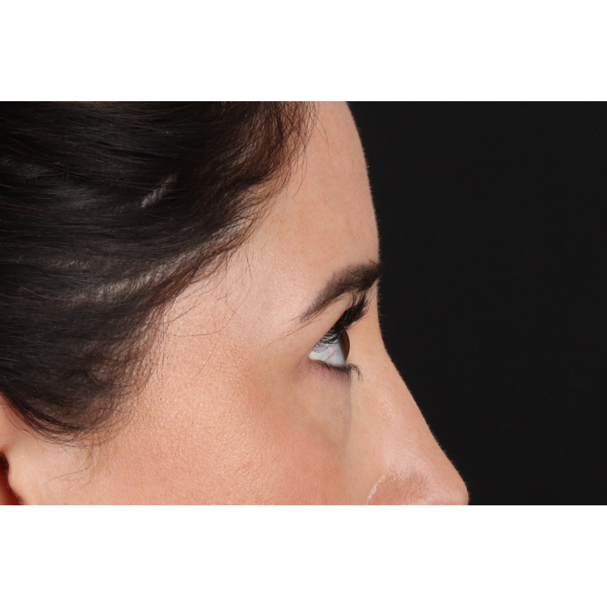 Blepharoplasty (Eyelid Surgery) Before & After Patient #11668