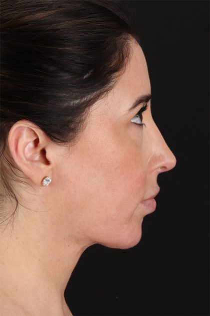 Fat Grafting To The Face Before & After Patient #11783