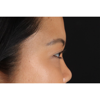 Brow Lift Before & After Patient #11646