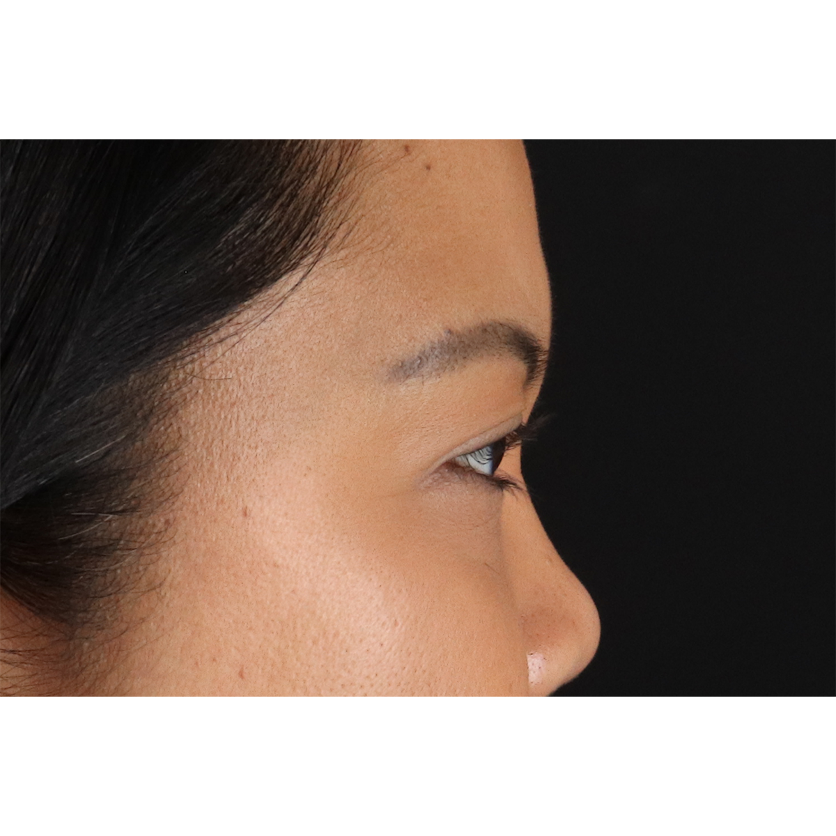 Brow Lift Before & After Patient #11646