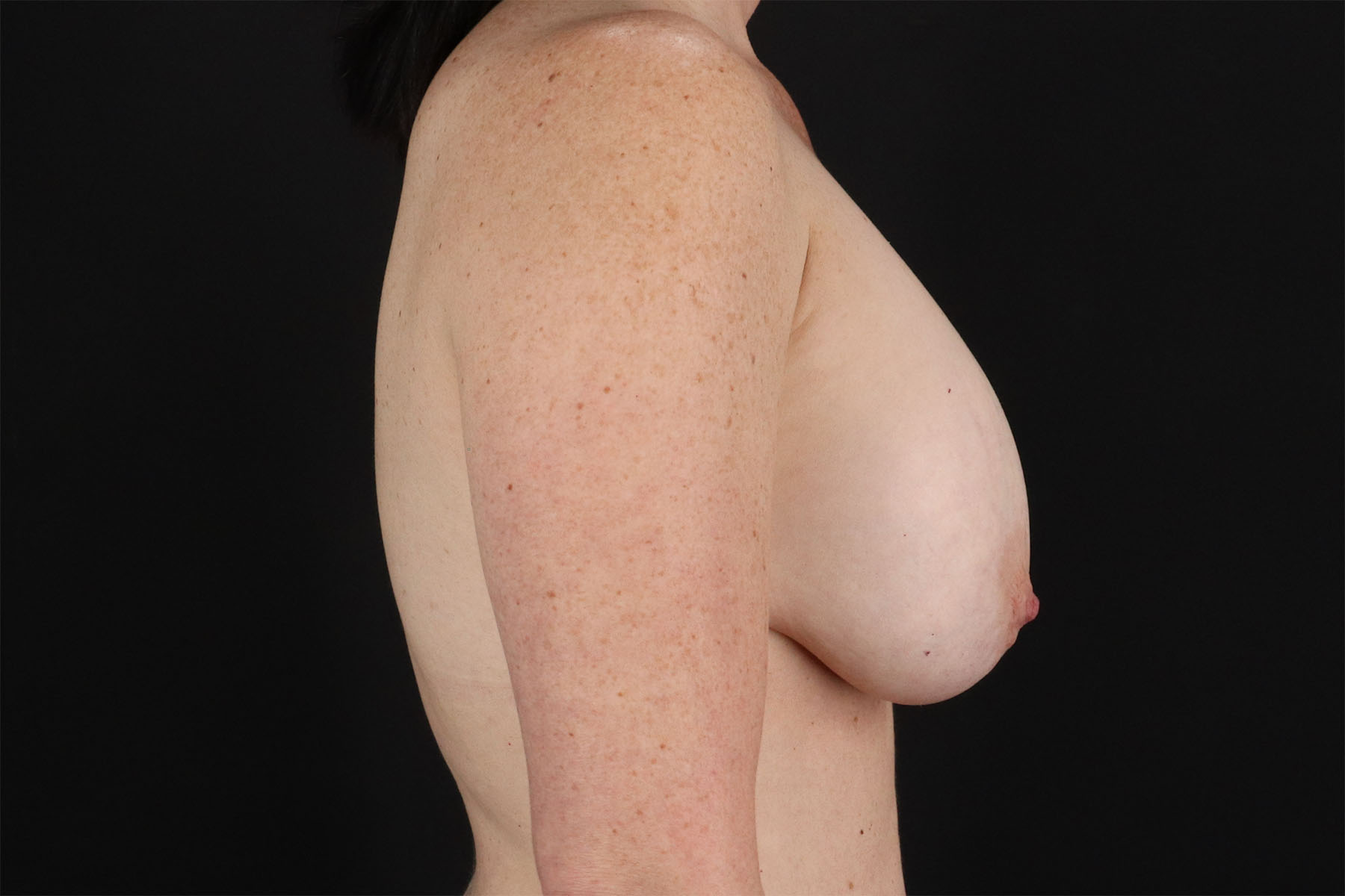 Breast Lift Before & After Patient #11180