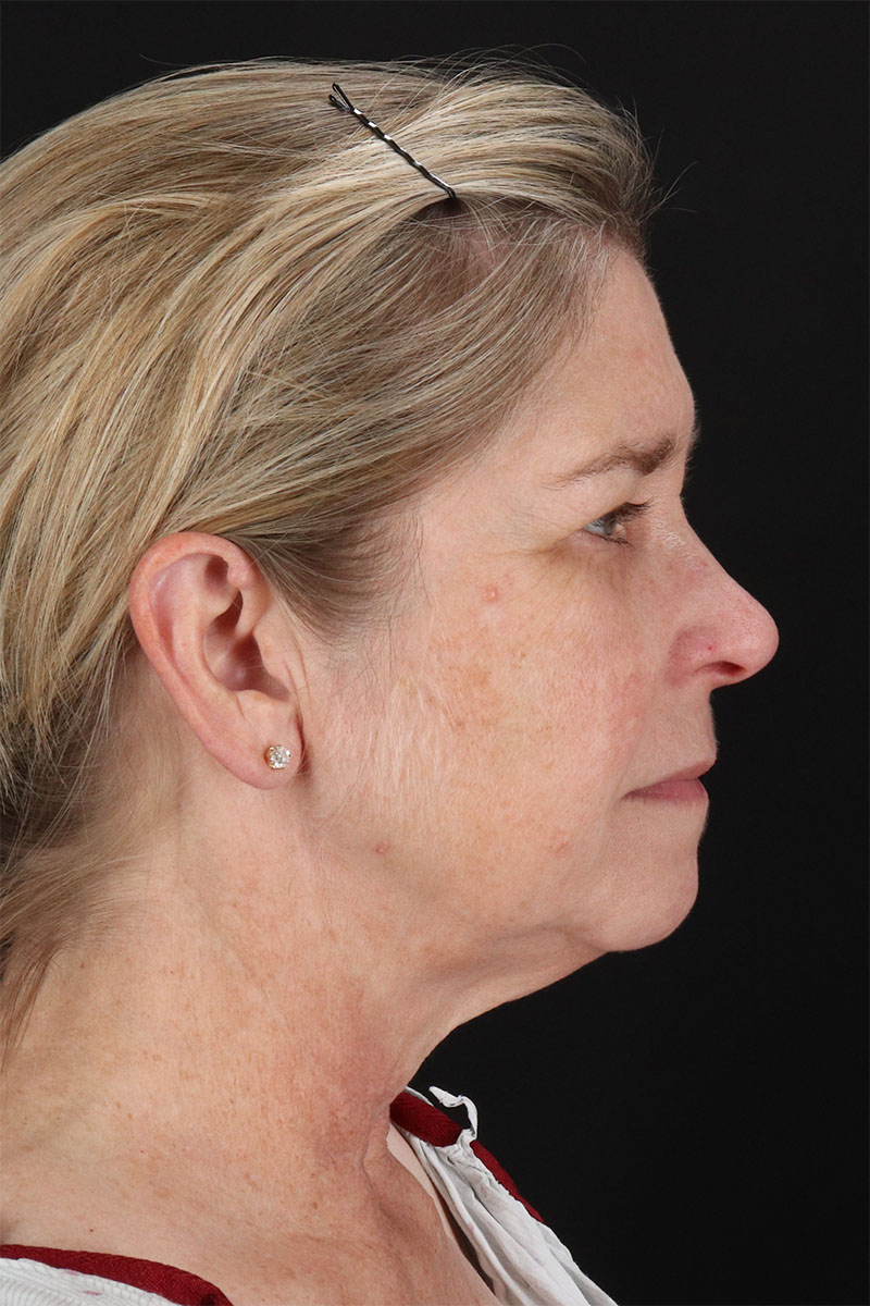 CO2 Laser Before & After Patient #11191