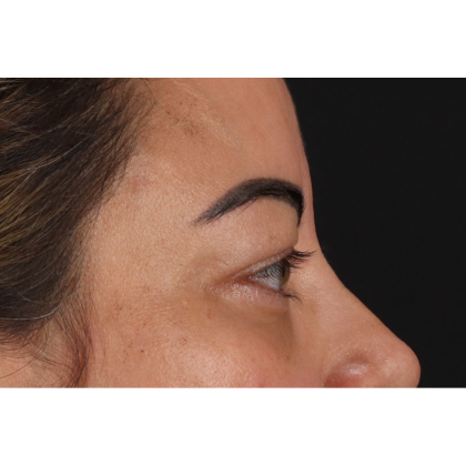 Blepharoplasty (Eyelid Surgery) Before & After Patient #11348
