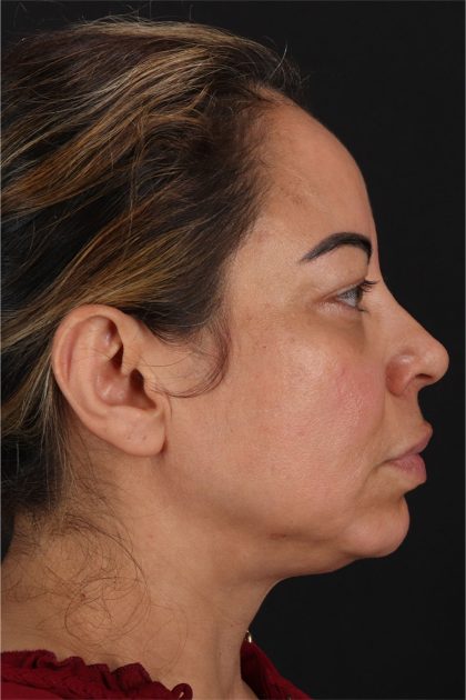 CO2 Laser Before & After Patient #11719