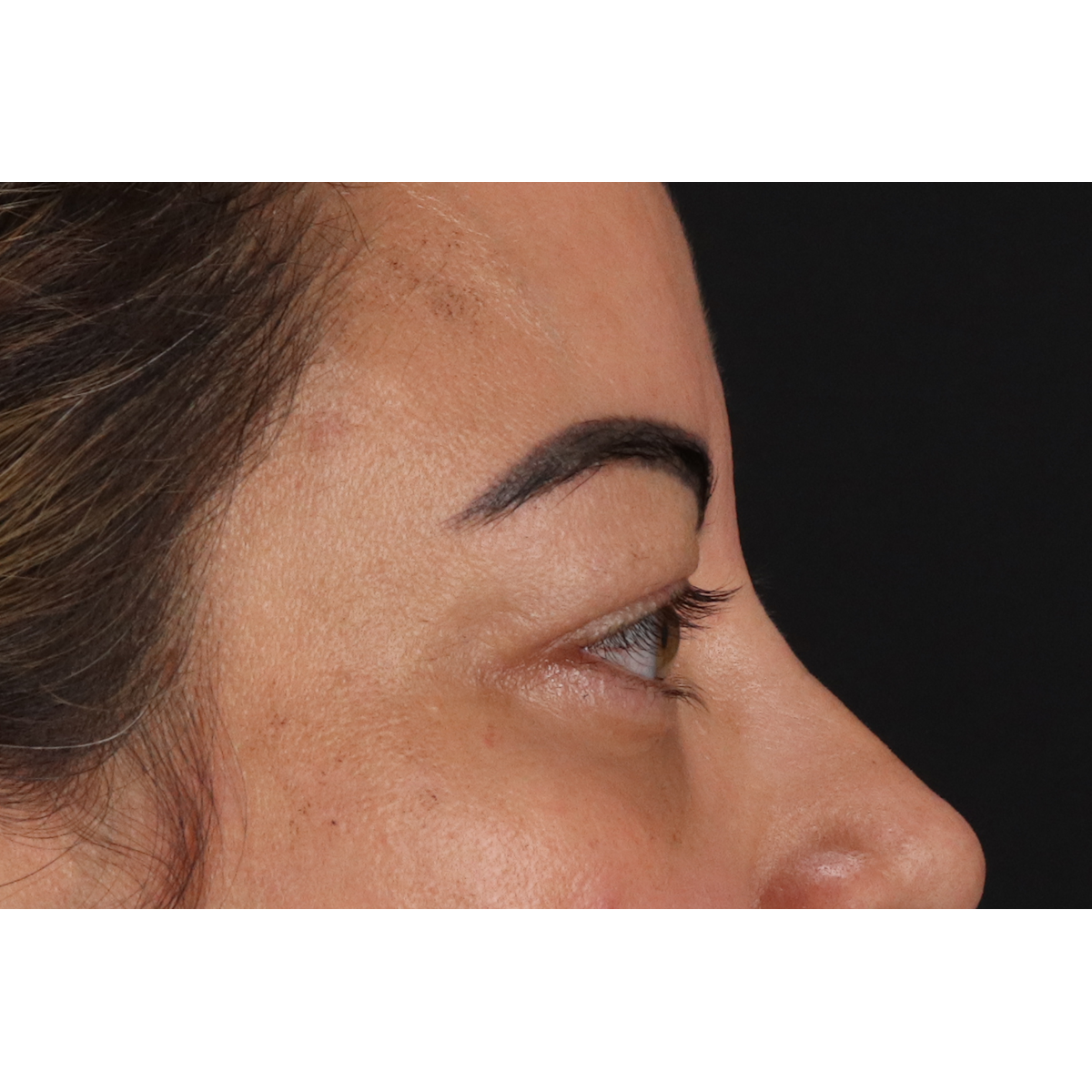 Blepharoplasty (Eyelid Surgery) Before & After Patient #11348