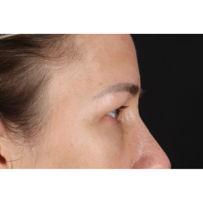 Blepharoplasty (Eyelid Surgery) Before & After Patient #11585