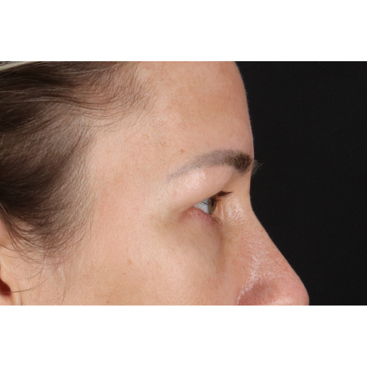 Blepharoplasty (Eyelid Surgery) Before & After Patient #11585