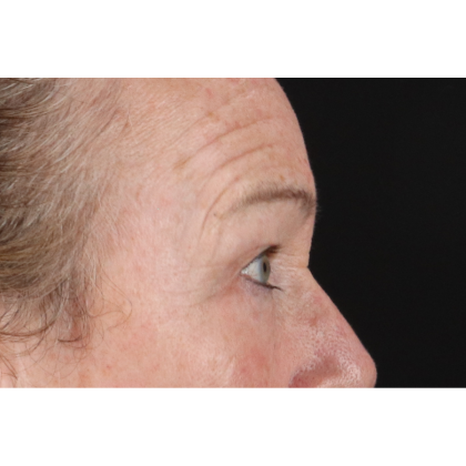 Blepharoplasty (Eyelid Surgery) Before & After Patient #11404
