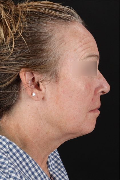 CO2 Laser Before & After Patient #11385