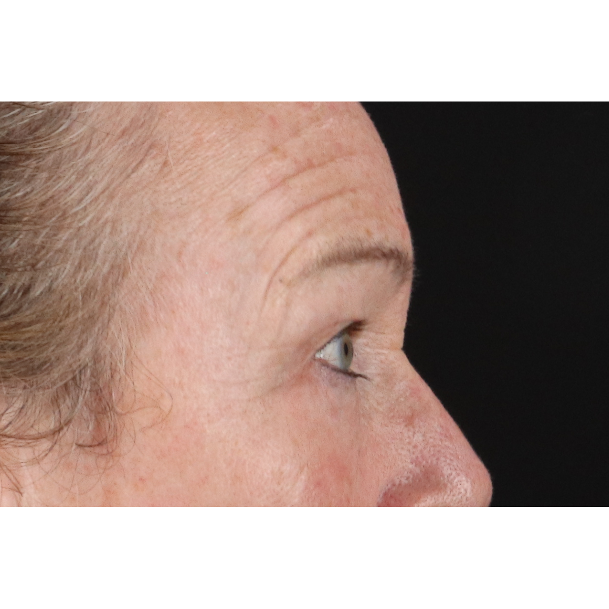 Blepharoplasty (Eyelid Surgery) Before & After Patient #11404