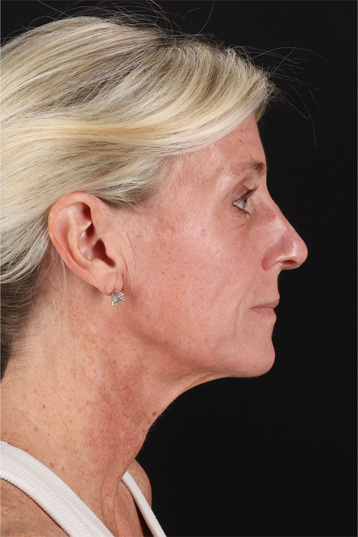 Facelift Before & After Patient #11682